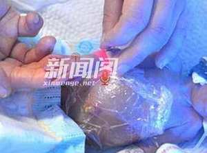 女嬰夭折捐腎救人 世界到處充滿了愛