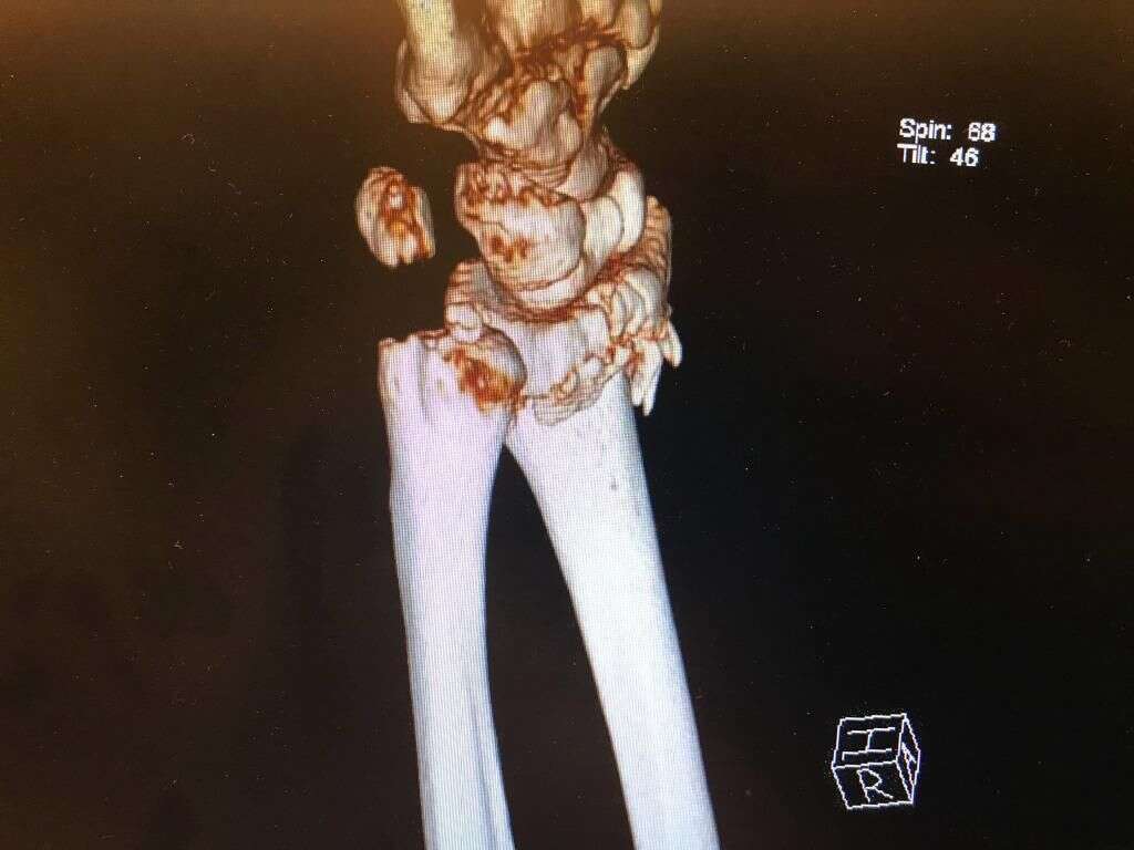 吴京突曝谢楠桡骨粉碎性骨折 晒ct照裂痕明显 吴京发微博表示心疼 楠木轩