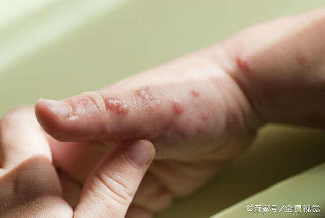 手 湿疹 水疱