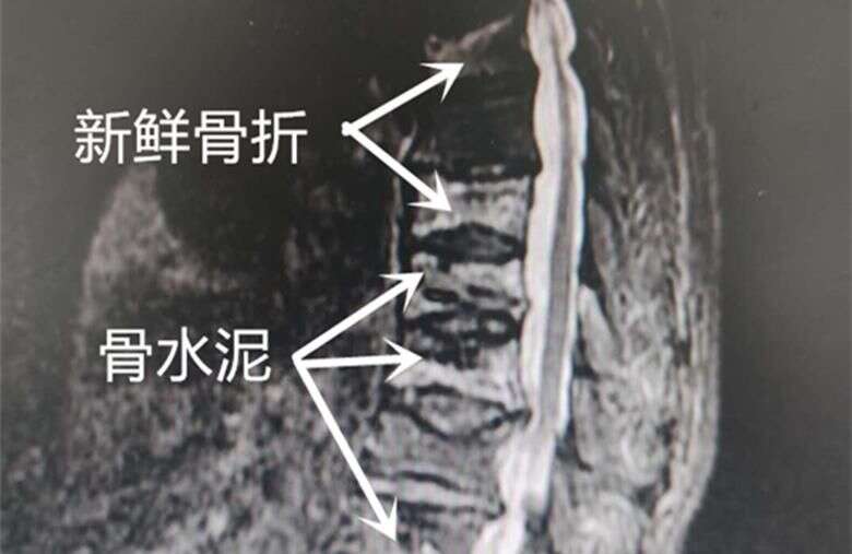 86歲王奶奶4次骨折經歷 總結出這個道理 楠木軒